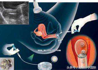 胚胎反复种植失败，再次备孕需要注意什么呢？