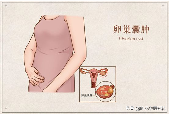 卵巢囊肿会导致不孕吗？卵巢囊肿的病因及预防，看这里